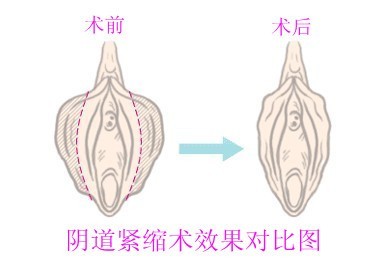 剖腹产会造成阴道松弛吗